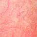 Rosacea